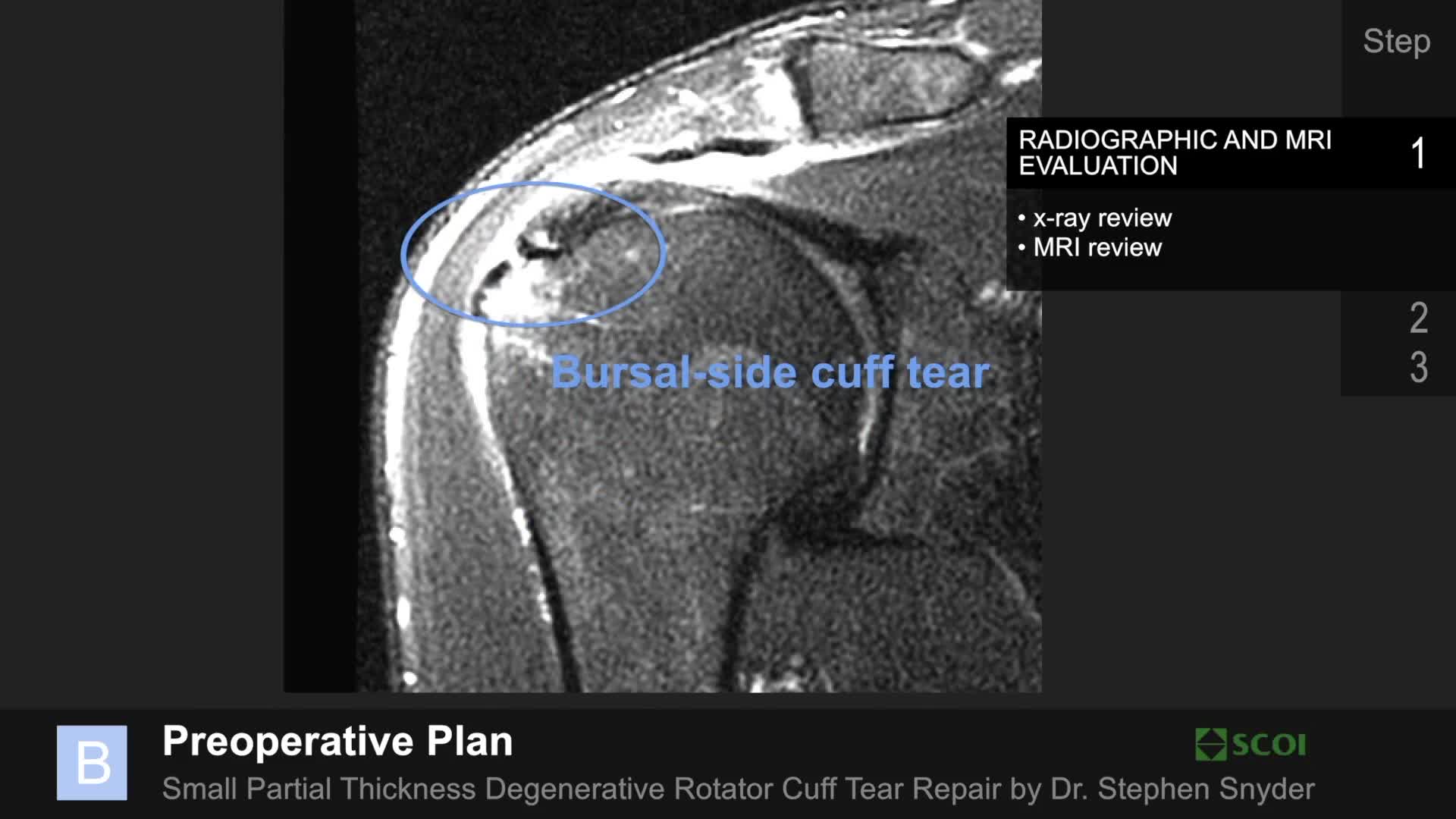 Partial Thickness Degenerative Rotator Cuff Tear Repair Arthroscopic