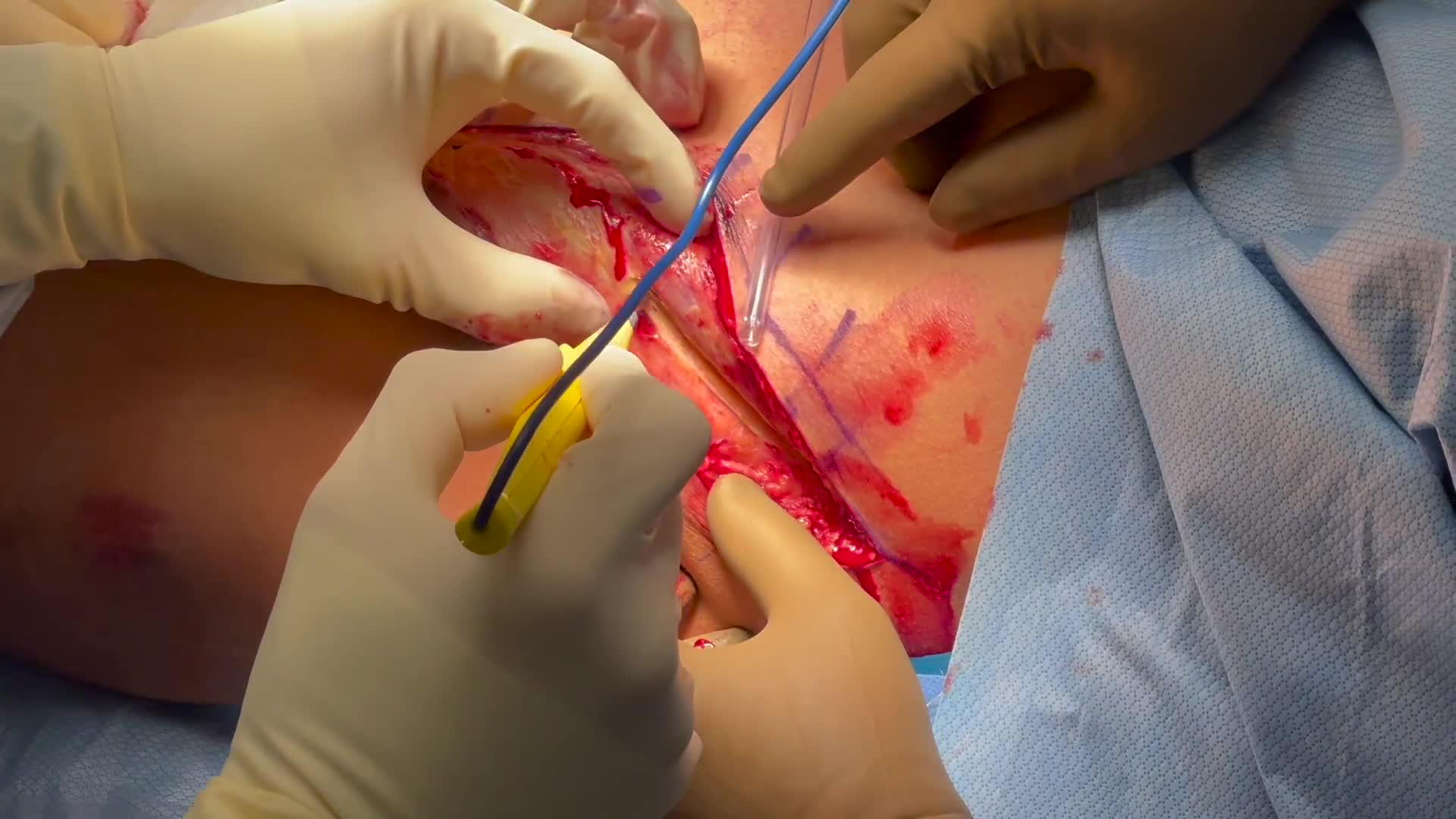 https://video.orthobullets.com/thumbs/020b16bb54e844188ad384d9b3655c5b/frame_0000.jpg